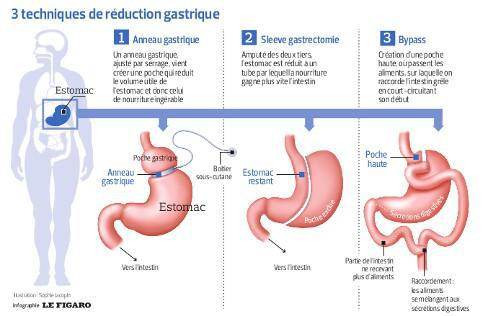 datant après la chirurgie de pontage gastriqueconseils de rencontres pour femme de 50 ans