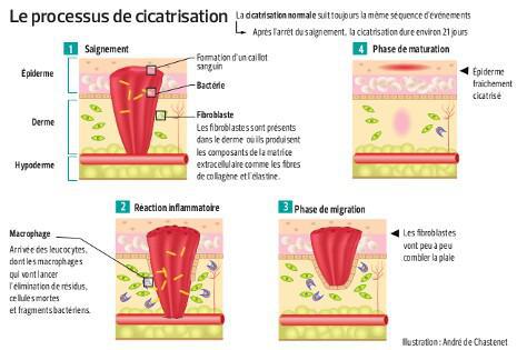 Cicatrisation : un phénomène difficile à maîtriser | SFR Presse